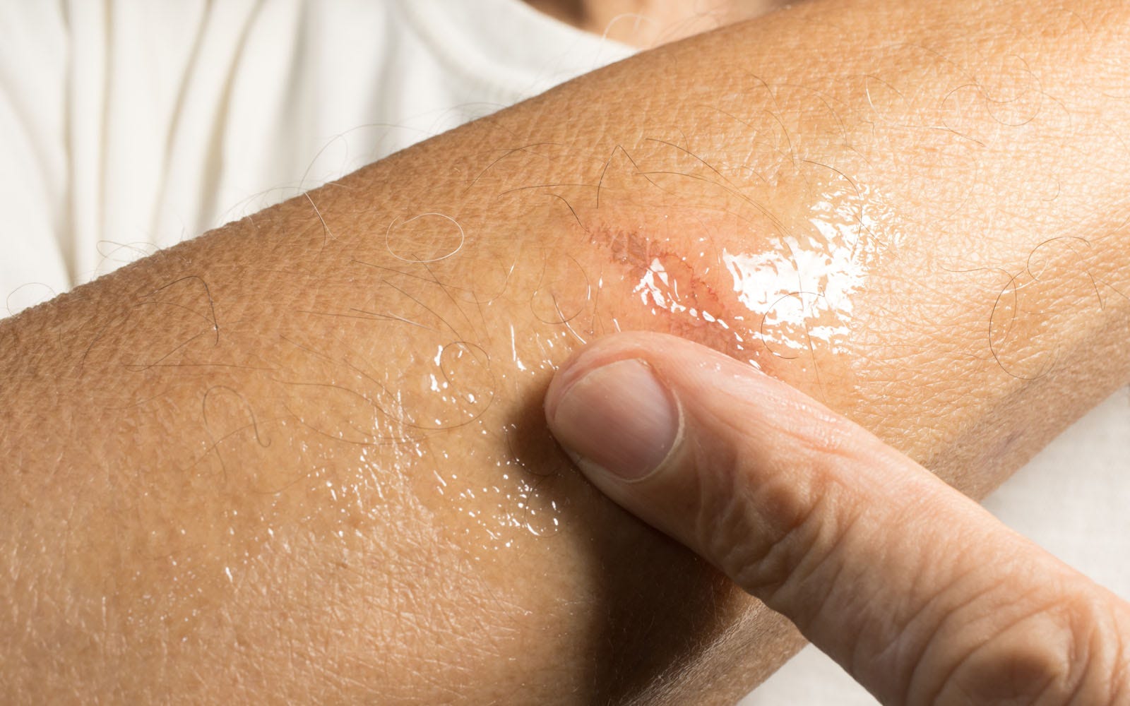 minor burn first aid